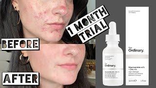 TESTING THE ORDINARY NIACINAMIDE AND ZINC FOR MY ACNE SCARRING FOR 1 MONTH [upl. by Raddy]