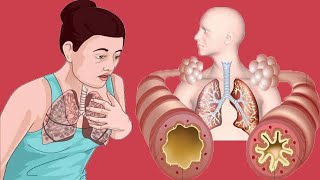 Cough Variant Asthma Causes And Symptoms [upl. by Aisylla]