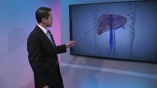 Liver Cancer Staging [upl. by Mcmahon805]