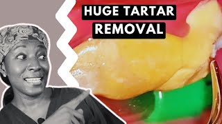 Massive TARTAR REMOVAL from teeth  TEETH CLEANING [upl. by Aderb]