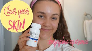 How To Get Rid of Acne  My Doxycycline Experience [upl. by Ulises]