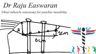 Tibial tubercle osteotomy TTO [upl. by Warfeld]