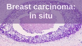 Breast Carcinoma in situ  Pathology mini tutorial [upl. by Olodort]