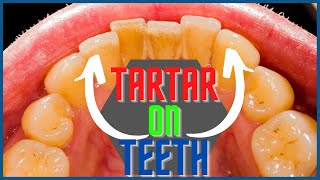 Tartar on teeth How to safely remove tartar buildup on teeth at home [upl. by Orpha693]