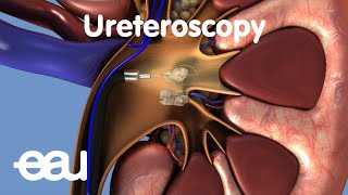 Removal of kidney stones URS [upl. by Kendal]