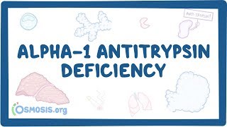 Alpha1 Antitrypsin Deficiency  causes symptoms diagnosis treatment pathology [upl. by Ydospahr]