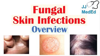 Overview of Fungal Skin Infections  Tinea Infections [upl. by Devehcoy165]