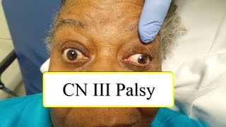 CN III Palsy [upl. by Saticilef]