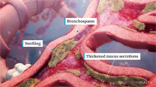 What Is Severe Asthma [upl. by Leitao]