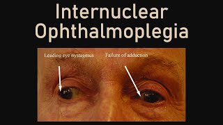 Internuclear Ophthalmoplegia [upl. by Milewski]