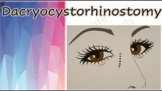 Dacryocystorhinostomy  DCR [upl. by Courtund67]