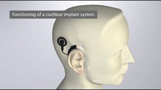 How Do Cochlear Implants Work The SYNCHRONY Cochlear Implant  MEDEL [upl. by Yelehsa]