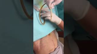 Suprapubic Catheter Change [upl. by Anerb380]