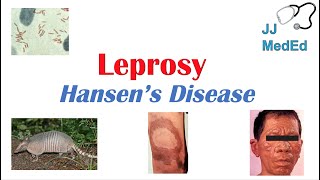 Leprosy Hansens disease  Who is at risk Signs and Symptoms Diagnosis and Treatment [upl. by Odraboel]