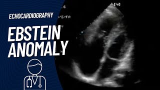 Ebstein Anomaly on Echocardiography [upl. by Cordula]